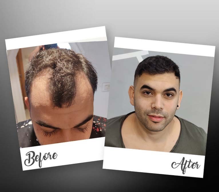ישראל סבג לפני ואחרי השתלת שיער